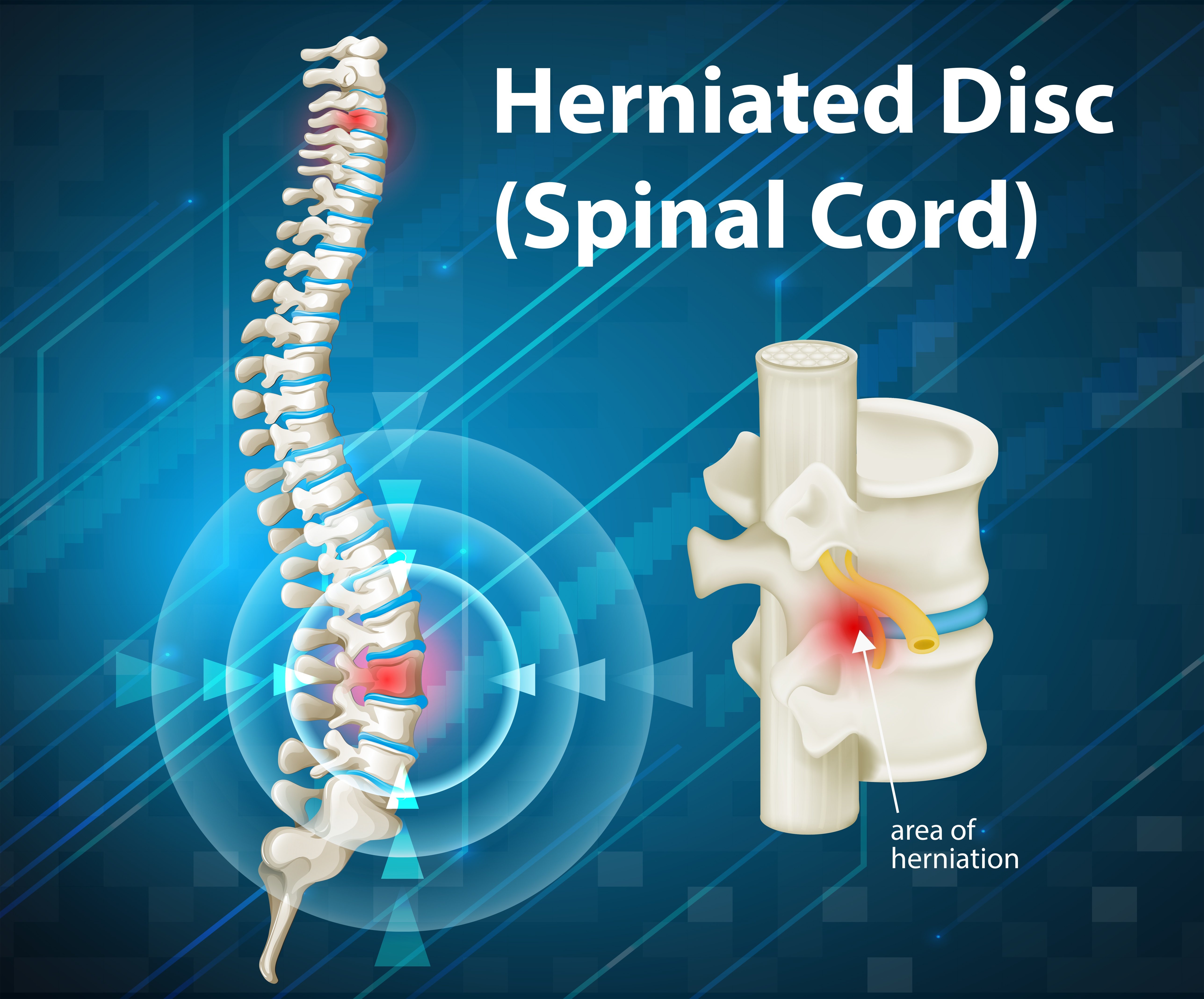 lumbar-vertebrae-w-herniated-disc-anatomical-spine-new-collectibles